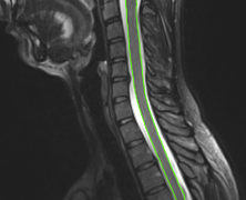 Automatic Spinal Cord Centerline Extraction on MR Images